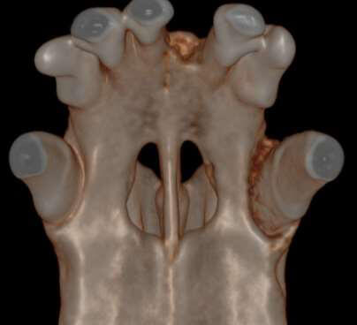 CT image after GTR done