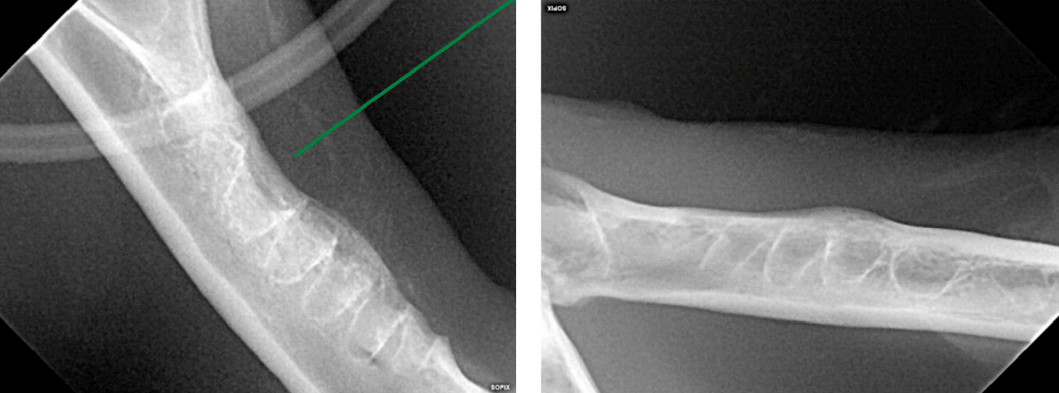 Radiographs after madibular extractions