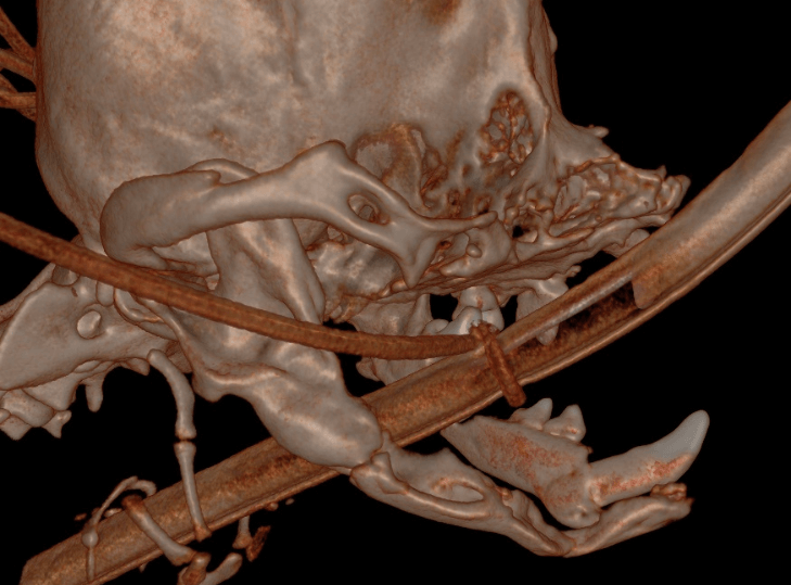 CT left side with left mandibular fracture