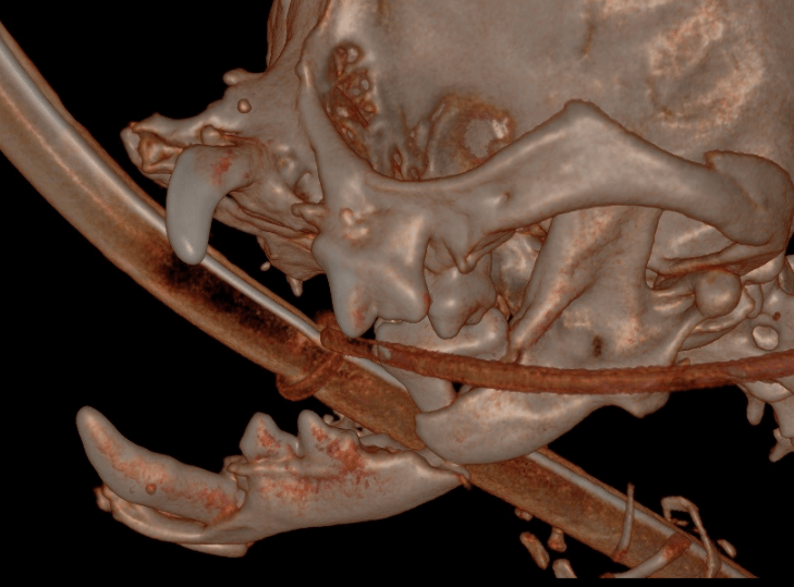 CT right side with right mandibular fracture