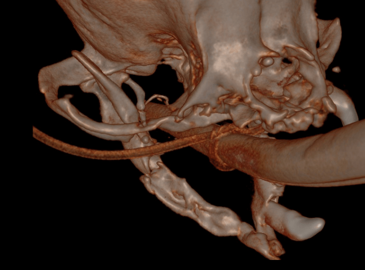 Thin mandibular bone