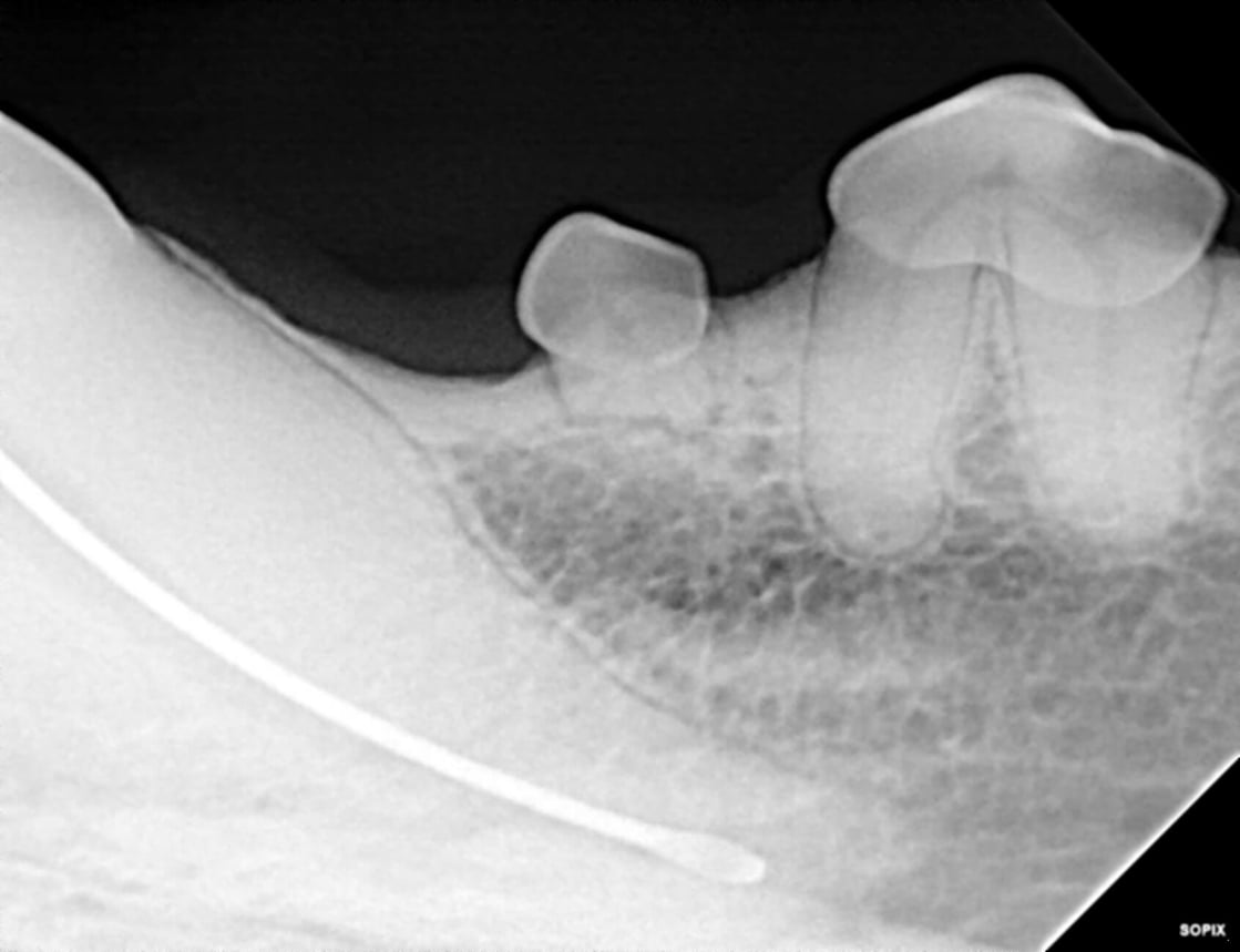 Worn Teeth May Need Root Canal Therapy