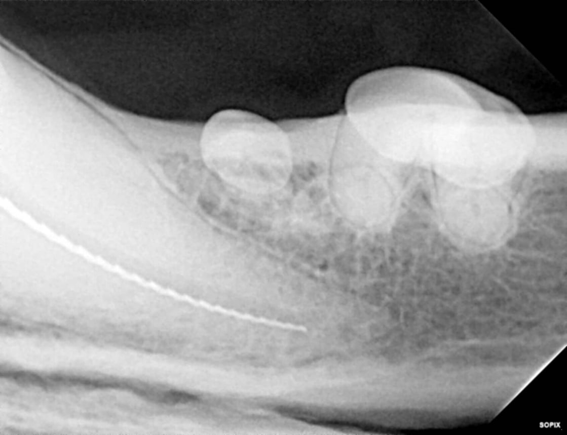 Worn Teeth May Need Root Canal Therapy