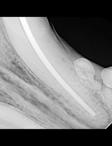 Dry fit gutta percha during RCT procedure 