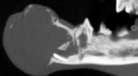 2 FIOT Rostral_MNectomy_Sep_2023_CT_06